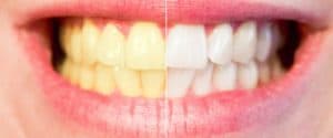 Sbiancare i denti