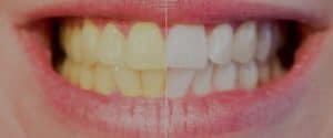 Sbiancare i denti