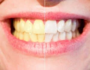 Sbiancare i denti devitalizzati