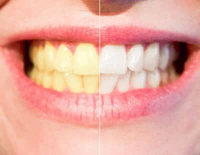Sbiancare i denti devitalizzati