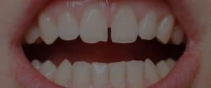 Frenulo e diastema