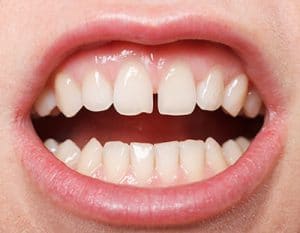 Frenulo e diastema