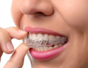 Invisalign